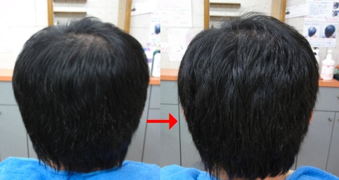 この写真のようなトリートメントをしていた97%の美容室は進化したシステム:マレーア・レナータトリートメントへ転換しています。なおこの施術に用いたミコノスは既に廃盤になりました。