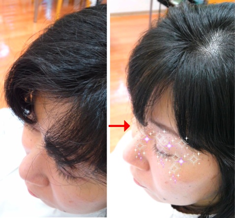この写真のようなサプリカラーは進化したシステム:マレーア・レナータカラーへ転換しています。なおこの施術に用いたミコノスは既に廃盤になりました。