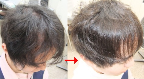 この写真のような縮毛矯正をされていた97%の美容室は進化したシステム:マレーア・レナータ縮毛矯正施術へ転換しています。なおこの施術に用いたミコノスは既に廃盤になりました。