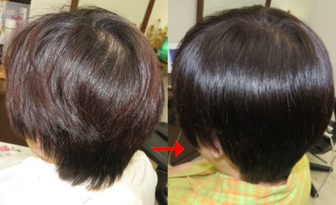 この写真のようなサプリカラーは進化したシステム:マレーア・レナータカラーへ転換しています。なおこの施術に用いたミコノスは既に廃盤になりました。
